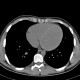 Anemia, heart: CT - Computed tomography